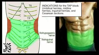 Ultrasound guided Quadratus Lumborum Block QLB1 [upl. by Haduhey]