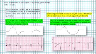 Retraso en la conducción intraauricular Clases EKG 15 [upl. by Sillek794]