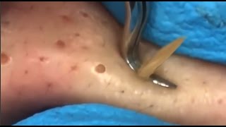 Blackhead Squeezed Pimple Removal [upl. by Louanna]