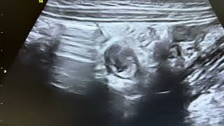 Ultrasound of terminal ileitis in 5 year boy with vomiting since 23 days [upl. by Akela]