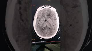 Glioma neetpg radiology [upl. by Naerad395]