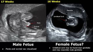 Fetal Gender Determination On Ultrasound  Determining The Sex Of A Baby On USG BoyGirl [upl. by Lleryt]