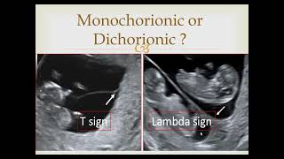 Monochorionic or dichorionic twins [upl. by Cenac]