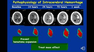 Evidence based management of intracerebral hemorrhage An update [upl. by Rhys]