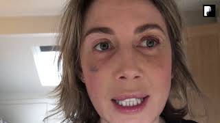 Blepharoplasty Video Diary  Day 10 After Surgery 8 of 15 [upl. by Winston891]