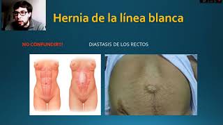 Hernias abdominales [upl. by Ahsytal]