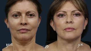 Facial Rejuvenation Neck lift  CO2 Laser  Before and After  Dr David Stoker [upl. by Aihsinyt747]