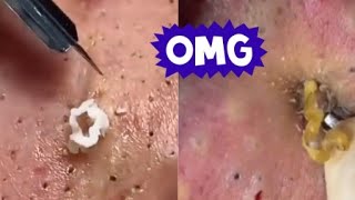 Top Acne Scar Treatments Proven Methods to Clear Your Skin Fast [upl. by Enert221]