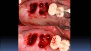 SOCKET GRAFTING 101 PART A [upl. by Autrey436]