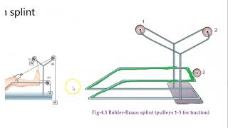 Orthopedics 045 bohler braun splint [upl. by Siraj]