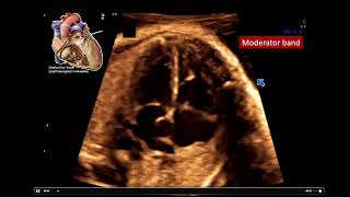 2022 Fetal Echocardiography Normal and Abnormal Hearts  A Video CME Teaching Activity [upl. by Talbott]