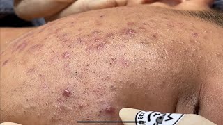 Blackheads amp Pimples Pore Removal New 2024  Acne Treatment With Bo Nguyễn Spa [upl. by Chiles608]