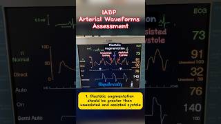 IABP Arterial Waveform Assessment cardiology criticalcare cathlab [upl. by Ailuj]