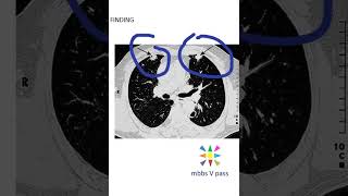 Medicine CT finding rheumatoid necrobiotic nodules thoracic image guess viva [upl. by Hutchinson234]