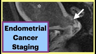 Endometrial Cancer Staging endometrialcancer radiology gynecology [upl. by Dworman]