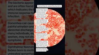 Neisseria gonorrhoeae is bacteria for gonorrhea sexually transmitted infection microbiology [upl. by Elyl]