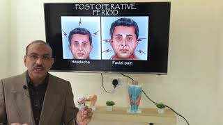 Deviated nasal septum Tamil Patient teaching programme [upl. by Belden]