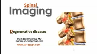 Spinal imaging Degenerative diseases II DRE Prof Mamdouh Mahfouz [upl. by Ycak52]