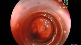 Ligation of Esophageal Varices HH Yen [upl. by Naresh]