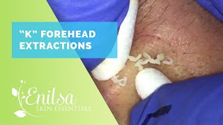 Blackheads Extractions on Draven 3rd treatment [upl. by Eudoxia610]