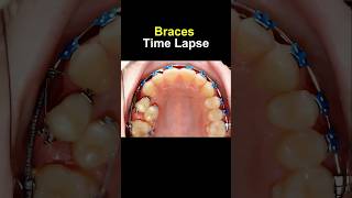 Braces time lapse Before and after transform braces orthodontist bracesoff dentist [upl. by Ondrea995]