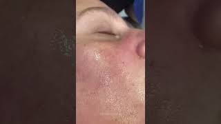 Clogged Pores amp how we unclog them  Dr Medispa [upl. by Otsuj]