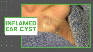 Inflamed Ear Cyst  Dr Derm [upl. by Erminie219]