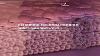 Solución Roche para la prevención de Cáncer Cervical [upl. by Lynch286]