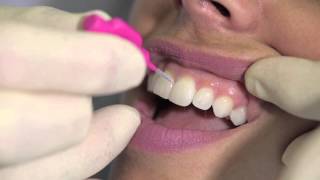 How to use an interdental brush  AJ Hedger [upl. by Ahsonek]