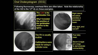 Radiography of the biliary system [upl. by Halie229]