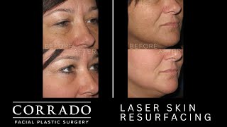 Fractional Laser Skin Resurfacing Treatment for SunDamaged Skin  Dr Anthony Corrado [upl. by Ecnatsnoc]