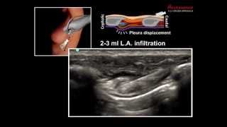 ULTRASOUND GUIDED INTERCOSTAL NERVE BLOCK [upl. by Adarbil]