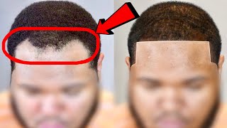 AMAZING Hairline Transformation RECEDING Hairline Restoration [upl. by Yenoh]