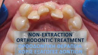 Nonextraction orthodontic treatment Pt BE [upl. by Ylekalb]