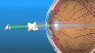 Multifocal Lens IOL [upl. by Cloutman]