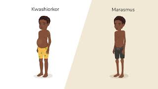 What is Malnutrition [upl. by Yerffoj]