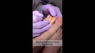 Mucous Cyst Draining [upl. by Crispas]