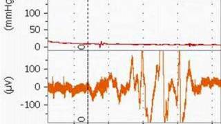 Bupivacaine Cardiotoxicity in an Anesthetized Rat [upl. by Dallas]