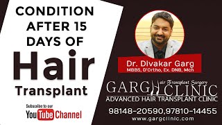 Condition amp Precautions after 15 days of Hair Transplant by DrDivakargarg Bathinda 919814820590 [upl. by Assilen]