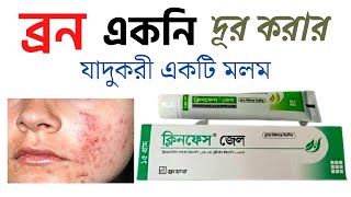 clinface gel  ব্রন ও ব্রনের দাগ দূর করার উপায়  ক্লিনফেস জেল  clinface gel review  cliface gel [upl. by Arualana]