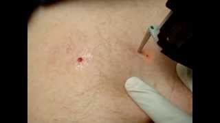 Cherry Angiomas Red Moles Treatment [upl. by Rozanna302]