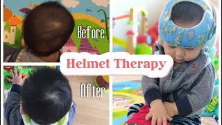 12 Weeks Progress Helmet Therapy For Flat Head SyndromePlagiocephaly [upl. by Enomaj]