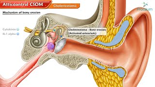 Atticoantral Chronic Suppurative Otitis Media CSOM and Cholesteatoma 🦻💡quot  Animated ENT Lectures [upl. by Aracahs]