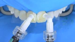 How To Use Ultradent Opalustre For Fluorosis Treatment [upl. by Chantalle419]