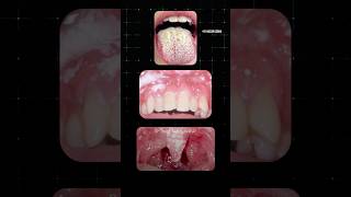 வாயில் ஏற்படும் பூஞ்சை தொற்று Oral Thrush Dr Isacc Abbas [upl. by Omarr]