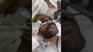 Laser treatment for Dark spots removal [upl. by Auqenwahs269]