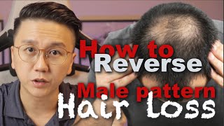 How to Reverse Male Pattern Baldness  Hair Loss in Men [upl. by Nirrek]