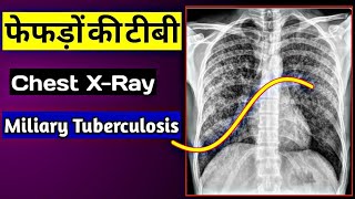 Chest XRay Normal vs TB Positive  Miliary Tuberculosis  Uday XRay [upl. by Annelak]