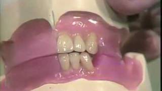 Setting Mandibular Anterior Teeth [upl. by Anertal]