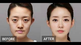 Why is Korea the plastic surgery Capital of the World [upl. by Gnex]